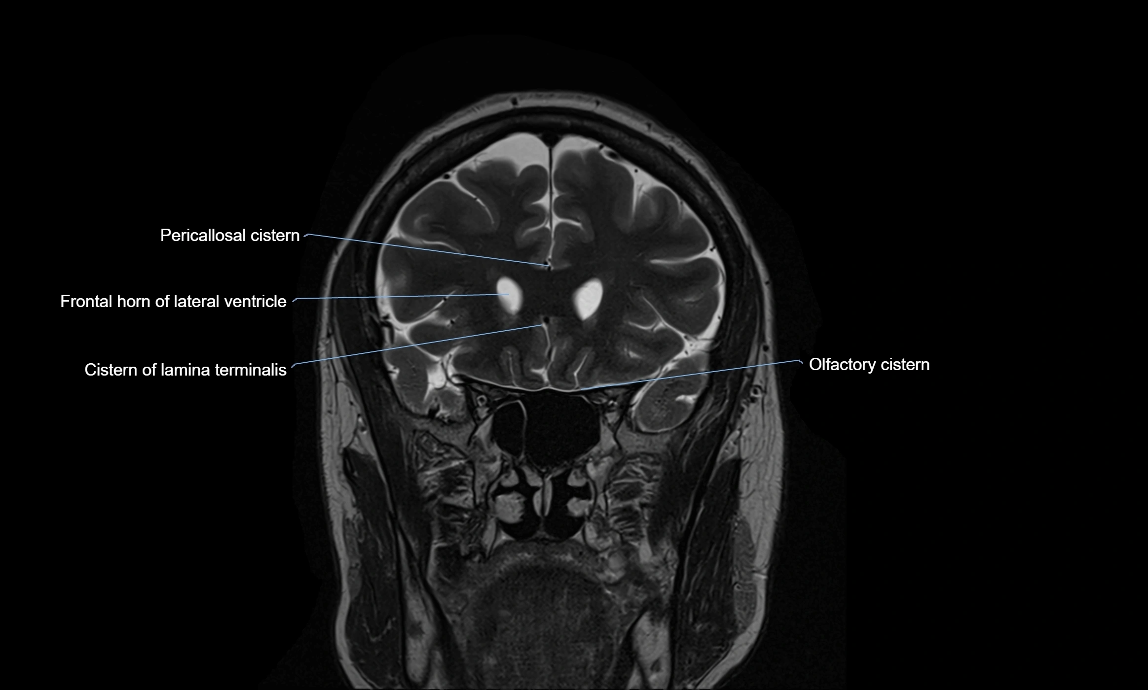 Brain cisterns  and ventricles coronal anatomy 3T MRI image-img-00001-00015.webp